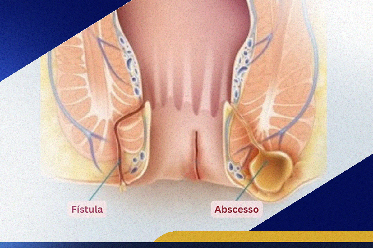 fístula anal; abscesso